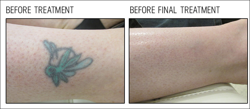 Laser Tattoo Removal Before  After Photos New Jersey  Reflections